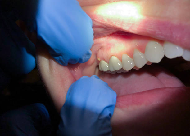Best Emergency Care for Gum Disease in Middleport, NY