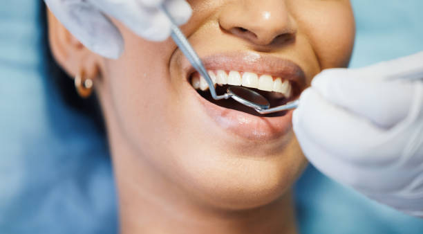 Best Knocked-Out Tooth (Avulsed Tooth) Treatment in Middleport, NY